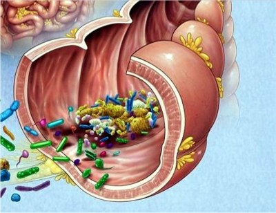 DISBIOSI INTESTINALE