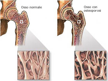 Cos'è l'osteoporosi