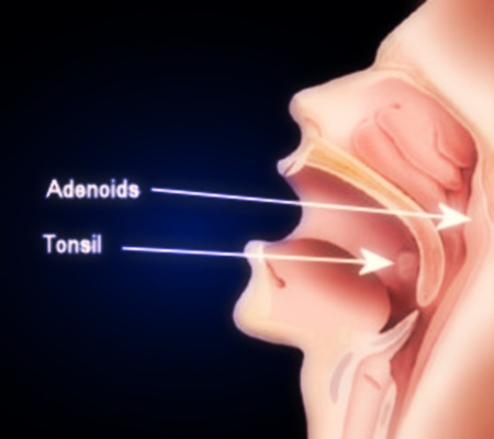 Adenoidi e tonsille